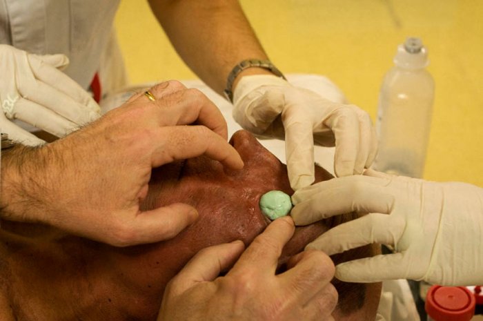 Explorando el cáncer - Acelerador Lineal - Un paciente con cáncer de piel