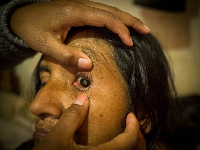 On Blindness, cataract surgery in Tarija (Bolivia) promoted by Eyes of The World Foundation