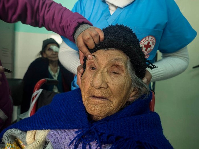 On Blindness, cataract surgery in Tarija (Bolivia) promoted by Eyes of The World Foundation