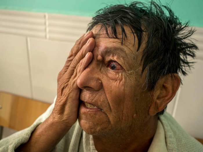 Ensayo sobre la ceguera, cirugía de cataratas en Tarija (Bolivia). Fundación Ojos del Mundo.